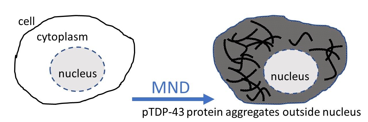 TDP aggregation in cytoplasm of cells as a signature of MND